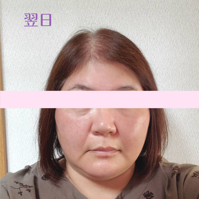 after画像